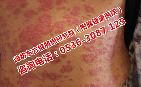 得了牛皮癬應(yīng)該去哪兒治療