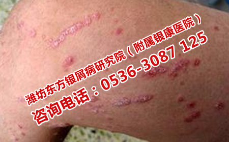 什么方法阻止牛皮癬復發(fā)