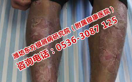 濰坊哪家牛皮癬醫(yī)院理想治理想膿皰型牛皮癬