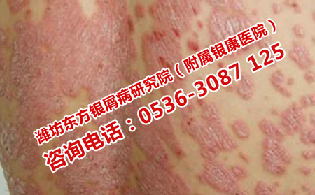 如何對(duì)牛皮癬進(jìn)行長(zhǎng)久護(hù)理