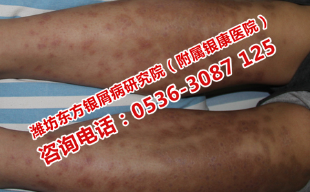 牛皮癬患者在日常應(yīng)該注意什么