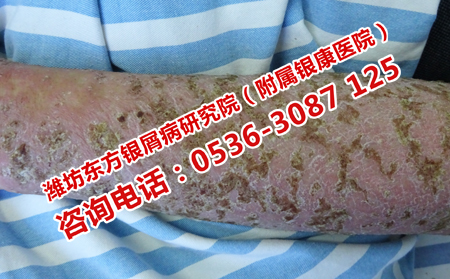 牛皮癬換吃點(diǎn)什么比較理想