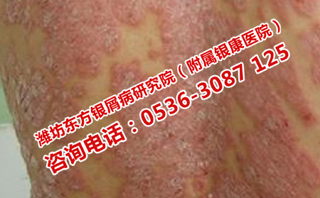 老年牛皮癬愈后怎樣護(hù)理
