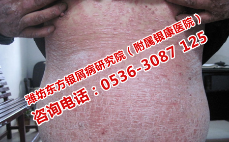 牛皮癬容易復(fù)發(fā)要怎樣護理