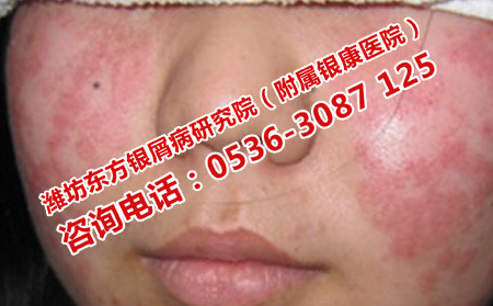 曬太陽(yáng)預(yù)防牛皮癬復(fù)發(fā)