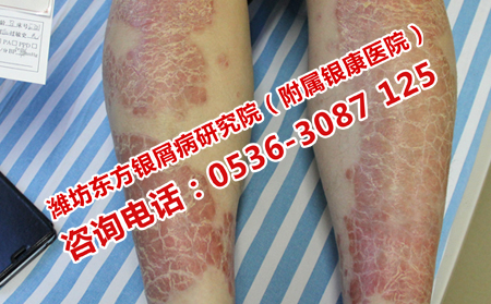 濰坊治銀屑病的費(fèi)用