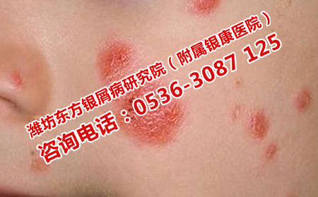 安丘理想點的銀屑病醫(yī)院