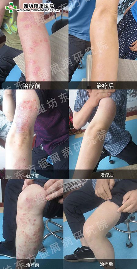 [山東]濰坊銀康醫(yī)院牛皮癬銀屑病治療康復(fù)對(duì)比圖