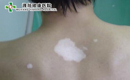 白癜風(fēng)發(fā)病部位,白癜風(fēng)長在哪個部位