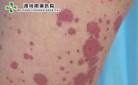 小兒過(guò)敏性紫癜的病因是什么?什么是過(guò)敏性紫癜?